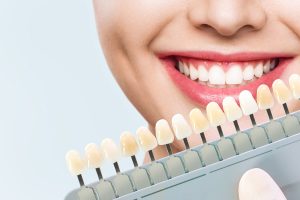 Dental Veneers  : The Secret to a Perfect Smile
